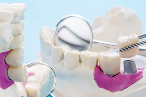 What Is A Prosthodontist?